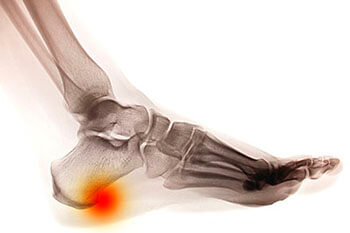 Heel spurs specialist in the Kings County, NY: Brooklyn (Midwood, Bay Ridge, Sunset Park, Bushwick, Park Slope, East New York, Williamsburg, Brighton Beach, Brownsville, Greenpoint, Brooklyn Heights, Kensington), Richmond County, NY: St. George, Midland Beach, and Queens County, NY: Elmhurst, Maspeth, Forest Hills areas